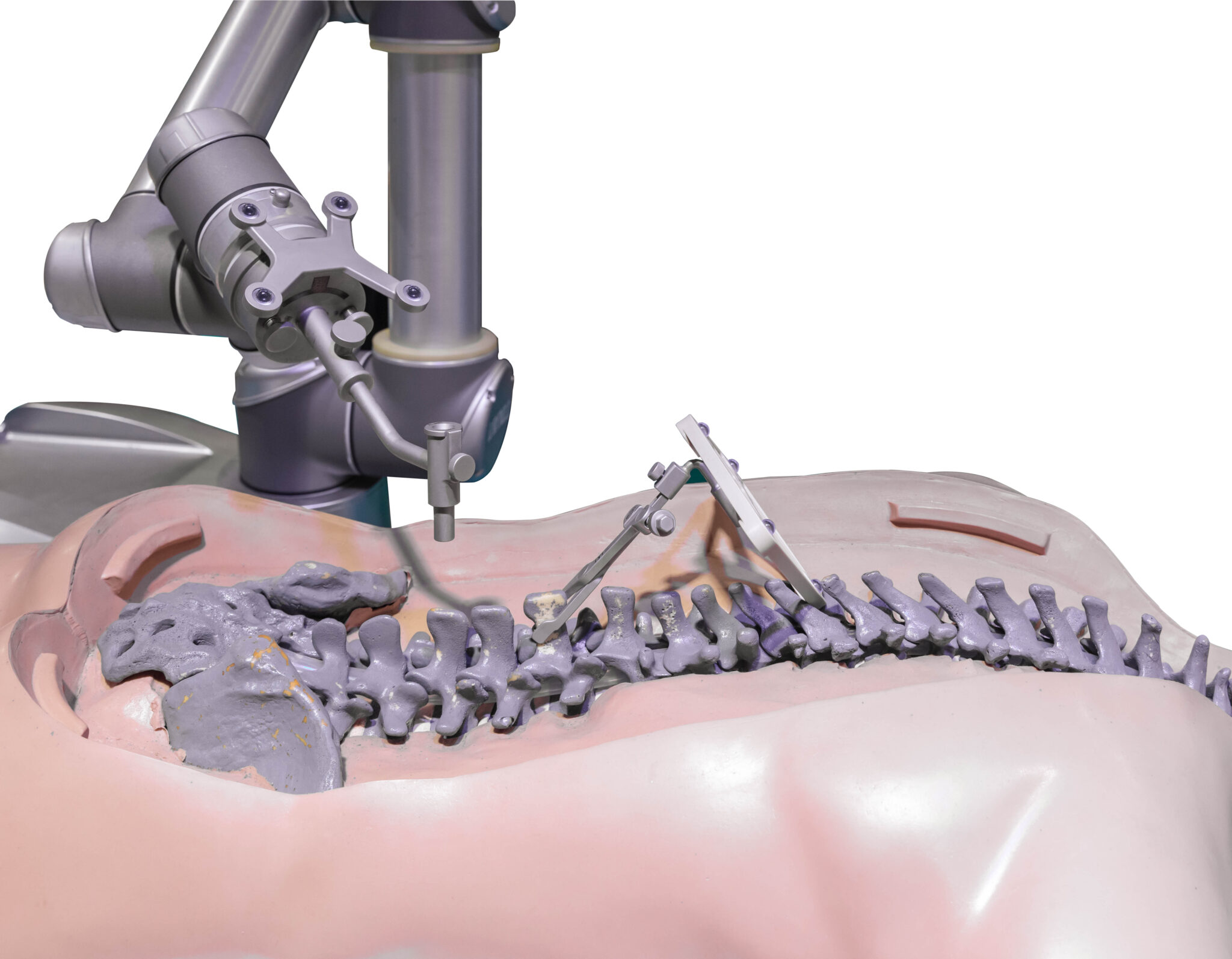 Robotic Spine Surgery And Augmented Reality Scopespine Virginia Maryland 1308